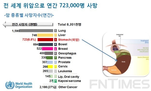 40대 전후 발생 사망률 높은 '조기발병위암' 원인 찾았다