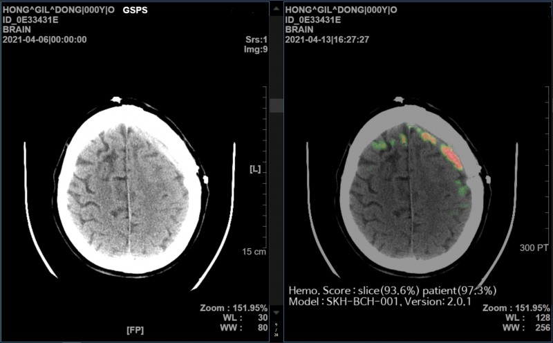SK㈜ C&C가 개발한 AI 뇌출혈 영상 의료 솔루션 ‘메디컬 인사이트 플러스 뇌출혈(Medical Insight+ Brain Hemorrhage)’의 효과성을 입증한 논문이 네이처 파트너 저널인 ‘디지털 메디신’에 게재됐다. 사진 제공=SK C&C