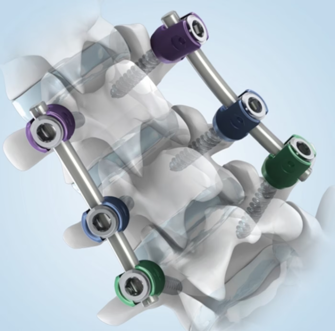 시지메드텍의 ANAX 5.5는 척추 후방 고정장치. /사진=시지메드텍