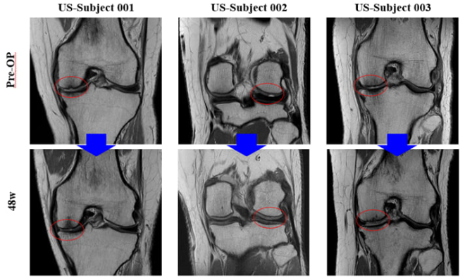 바이오솔루션이 10일(현지 시간) 미국 샌디에이고에서 열린 ‘미국 정형외과 학회(AAOS 2025)’에 참석해 미국 임상 2상 중간결과를 발표했다. 수술 전 환자(위)의 무릎 연골이 수술 후(아래) 개선됐음을 확인할 수 있다. /사진=바이오솔루션 제공