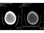 SK C&C, ‘AI 뇌출혈 영상 의료 솔루션’ 전문의 수준으로 진단
